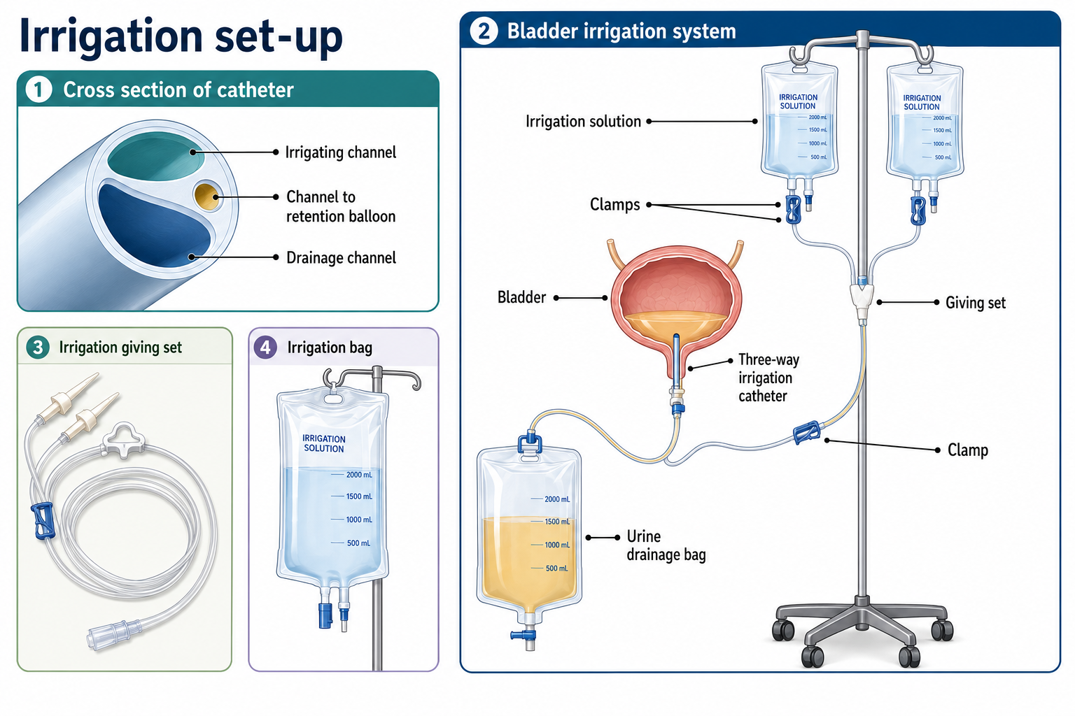 Irrigation set-up — 3-way catheter cross-section, giving set, irrigation bags and drainage bag